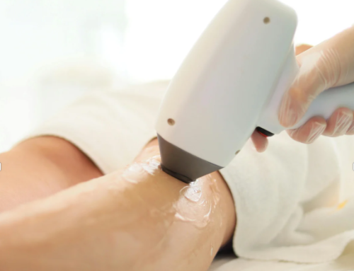 Epilazione Laser Definitiva: Quante Sedute Servono Davvero?